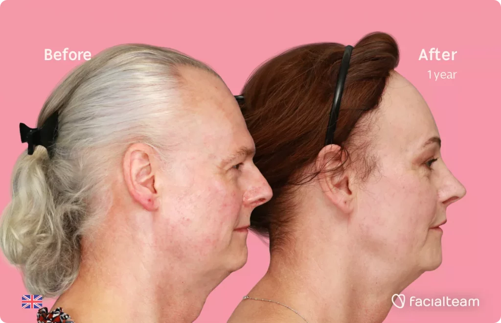 Right side image of FFS patient Deena showing the results before and after facial feminization surgery with Facialteam consisting of forehead feminization with SHT, jaw and chin feminization, rhinoplasty and tracheal shave.