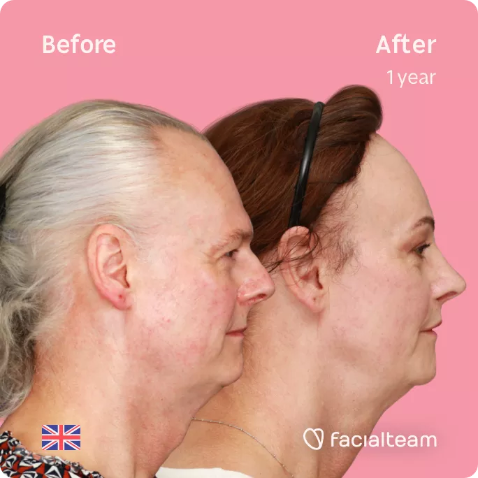 Square right side image of FFS patient Deena showing the results before and after facial feminization surgery with Facialteam consisting of forehead feminization with SHT, jaw and chin feminization, rhinoplasty and tracheal shave.