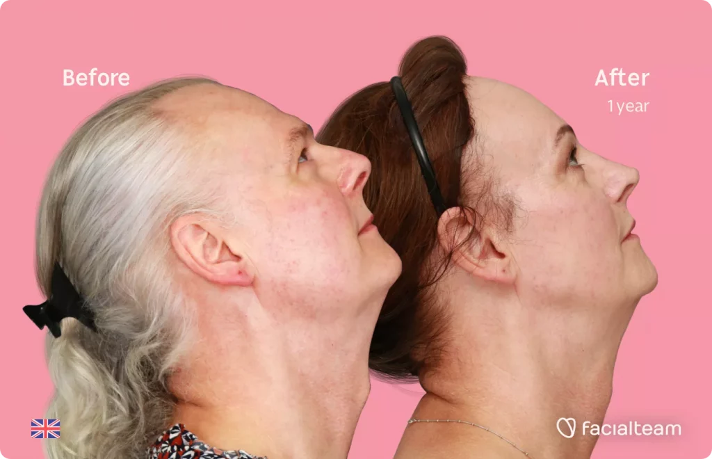 Right side up image of FFS patient Deena showing the results before and after facial feminization surgery with Facialteam consisting of forehead feminization with SHT, jaw and chin feminization, rhinoplasty and tracheal shave.