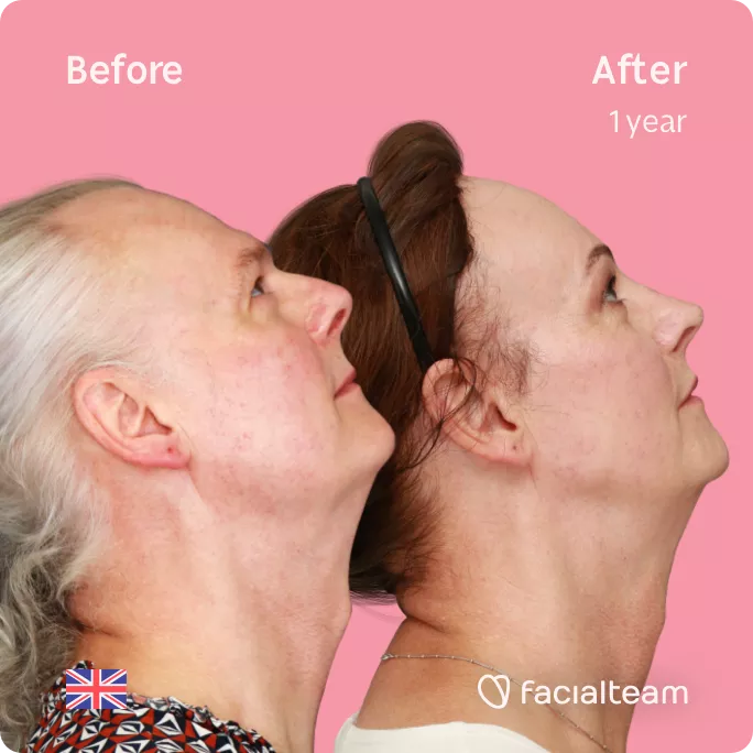 Square right side up image of FFS patient Deena showing the results before and after facial feminization surgery with Facialteam consisting of forehead feminization with SHT, jaw and chin feminization, rhinoplasty and tracheal shave.