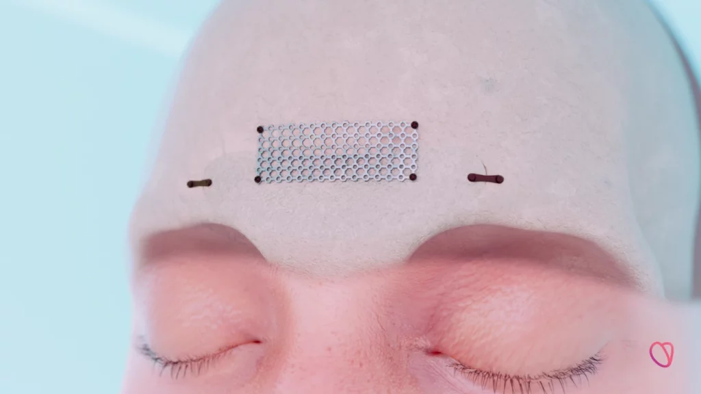 Facialteam titanium mesh in 3D