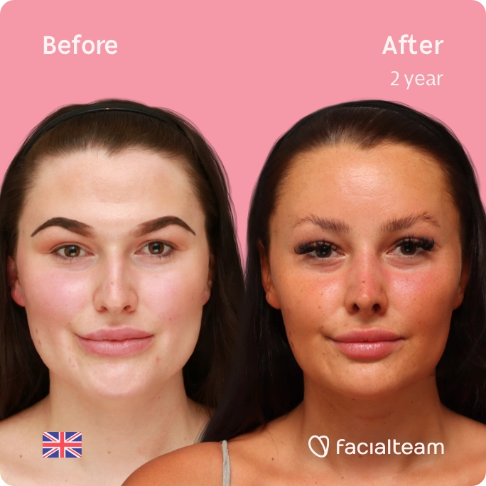 Square frontal image of FFS patient Summer showing the results before and after facial feminization surgery with Facialteam consisting of forehead feminization, jaw and chin feminization, and rhinoplasty.