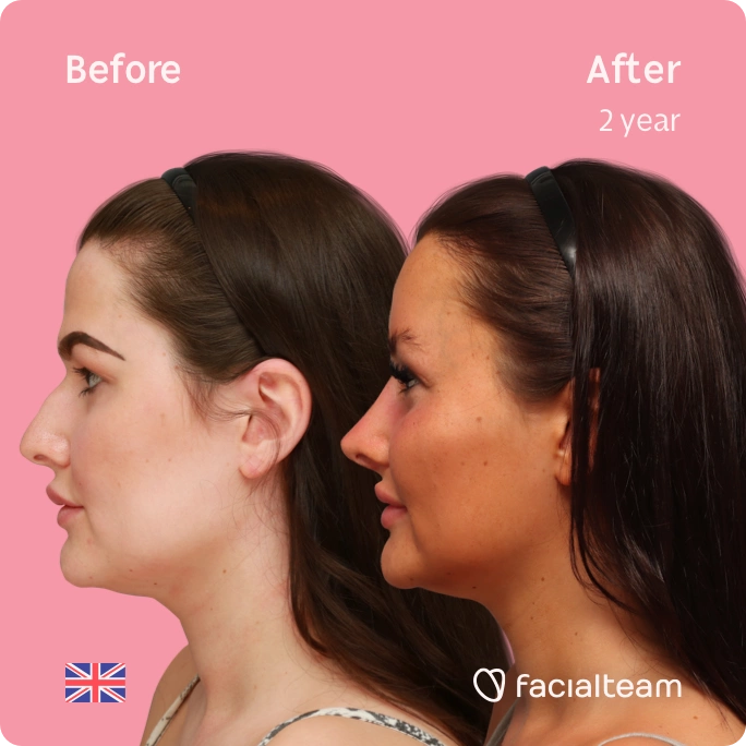 Square side image of FFS patient Summer showing the results before and after facial feminization surgery with Facialteam consisting of forehead feminization, jaw and chin feminization, and rhinoplasty.