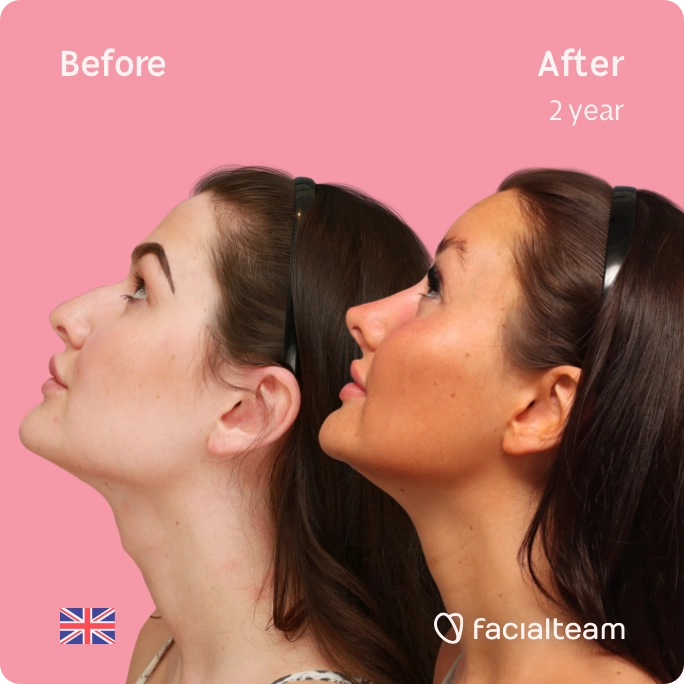 Square side up image of FFS patient Summer showing the results before and after facial feminization surgery with Facialteam consisting of forehead feminization, jaw and chin feminization, and rhinoplasty.