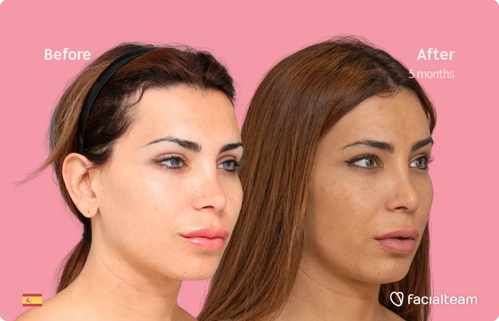 45 degree angle image of FFS patient Daniela R showing the results before and after facial feminization surgery with Facialteam consisting of forehead and lip feminization.