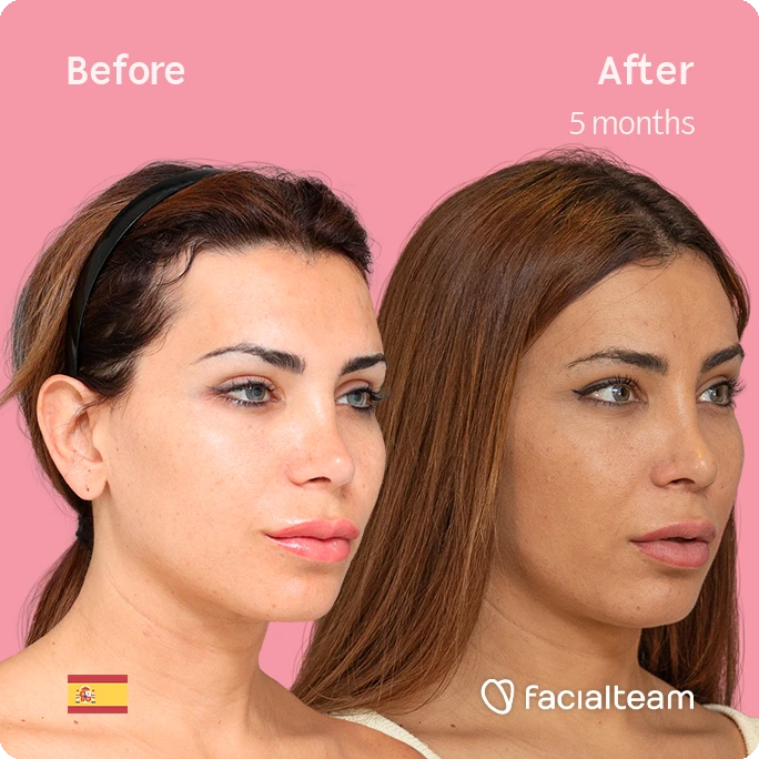 Square 45 degree angle image of FFS patient Daniela R showing the results before and after facial feminization surgery with Facialteam consisting of forehead and lip feminization.