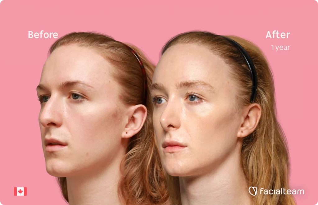 45 degree left angle image of FFS patient Isla showing the results before and after facial feminization surgery with Facialteam consisting of forehead with SHT, jaw, chin, rhinoplasty and tracheal shave feminization.