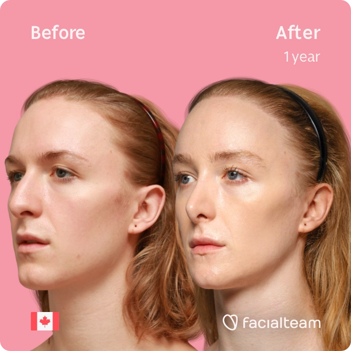 Square 45 degree left angle image of FFS patient Isla showing the results before and after facial feminization surgery with Facialteam consisting of forehead with SHT, jaw, chin, rhinoplasty and tracheal shave feminization.