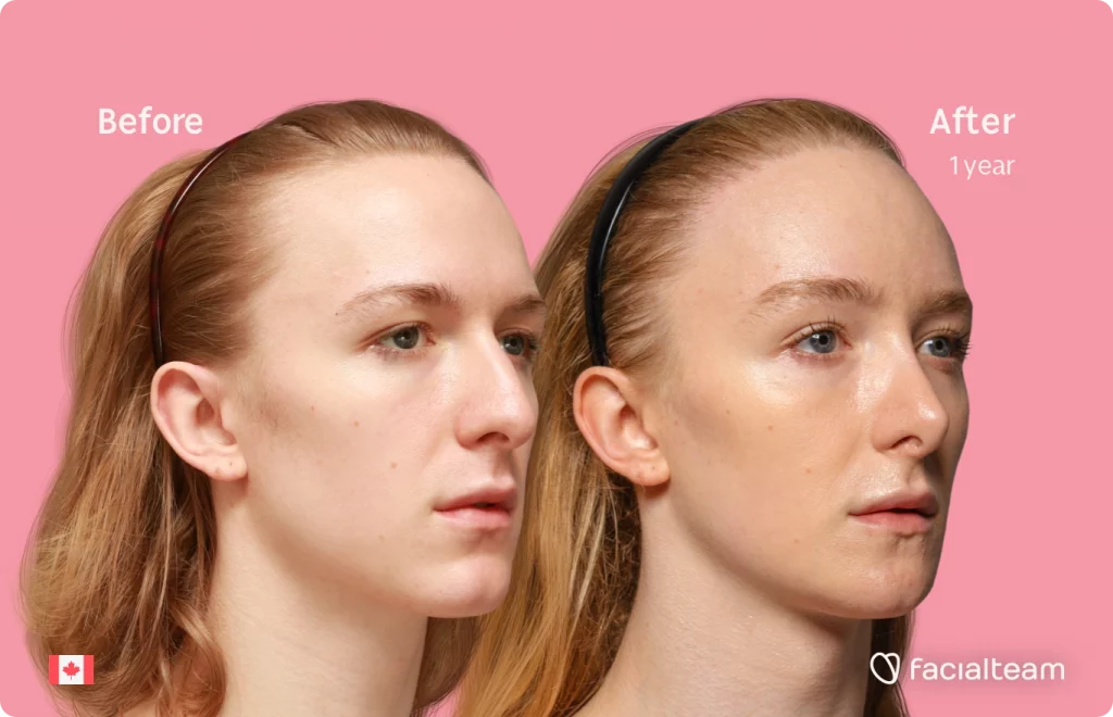 45 degree right angle image of FFS patient Isla showing the results before and after facial feminization surgery with Facialteam consisting of forehead with SHT, jaw, chin, rhinoplasty and tracheal shave feminization.