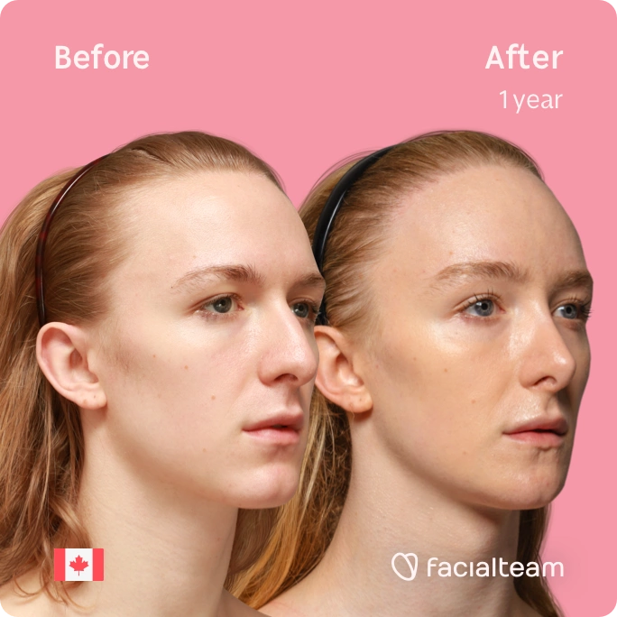 Square 45 degree right angle image of FFS patient Isla showing the results before and after facial feminization surgery with Facialteam consisting of forehead with SHT, jaw, chin, rhinoplasty and tracheal shave feminization.