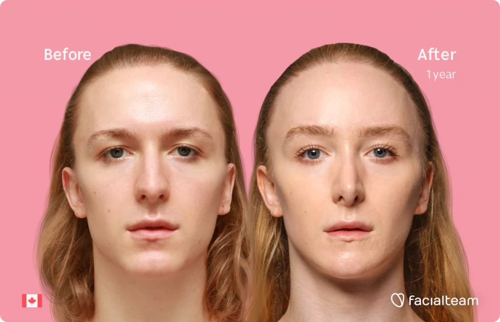 Frontal image of FFS patient Isla showing the results before and after facial feminization surgery with Facialteam consisting of forehead with SHT, jaw, chin, rhinoplasty and tracheal shave feminization.