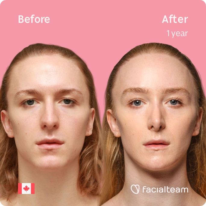 Square frontal image of FFS patient Isla showing the results before and after facial feminization surgery with Facialteam consisting of forehead with SHT, jaw, chin, rhinoplasty and tracheal shave feminization.