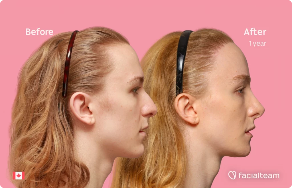Side image of FFS patient Isla showing the results before and after facial feminization surgery with Facialteam consisting of forehead with SHT, jaw, chin, rhinoplasty and tracheal shave feminization.