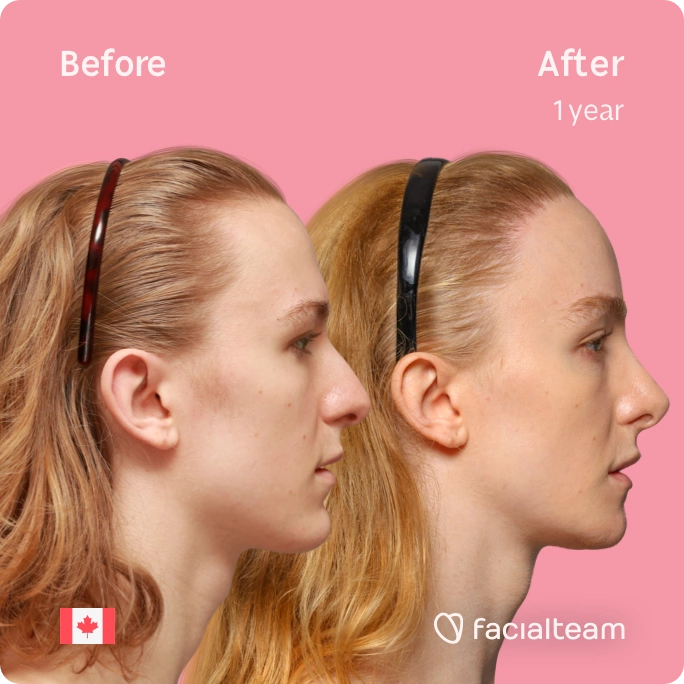 Square side image of FFS patient Isla showing the results before and after facial feminization surgery with Facialteam consisting of forehead with SHT, jaw, chin, rhinoplasty and tracheal shave feminization.