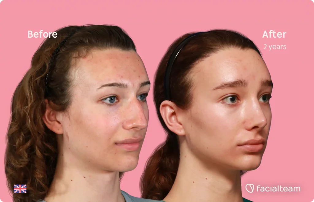 45 degree angle image of FFS patient Amelia showing the results before and after facial feminization surgery with Facialteam consisting of forehead with SHT and rhinoplasty.