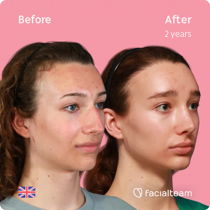 Square 45 degree angle image of FFS patient Amelia showing the results before and after facial feminization surgery with Facialteam consisting of forehead with SHT and rhinoplasty.