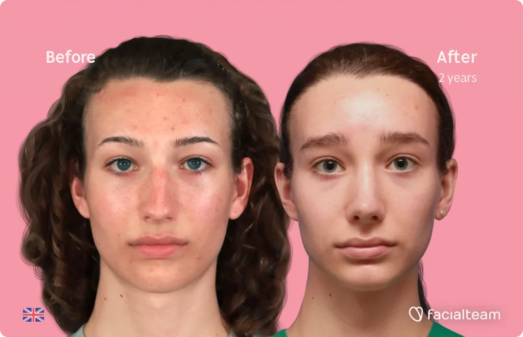 Frontal image of FFS patient Amelia showing the results before and after facial feminization surgery with Facialteam consisting of forehead with SHT and rhinoplasty.
