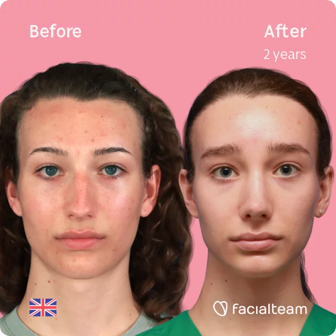 Square frontal image of FFS patient Amelia showing the results before and after facial feminization surgery with Facialteam consisting of forehead with SHT and rhinoplasty.