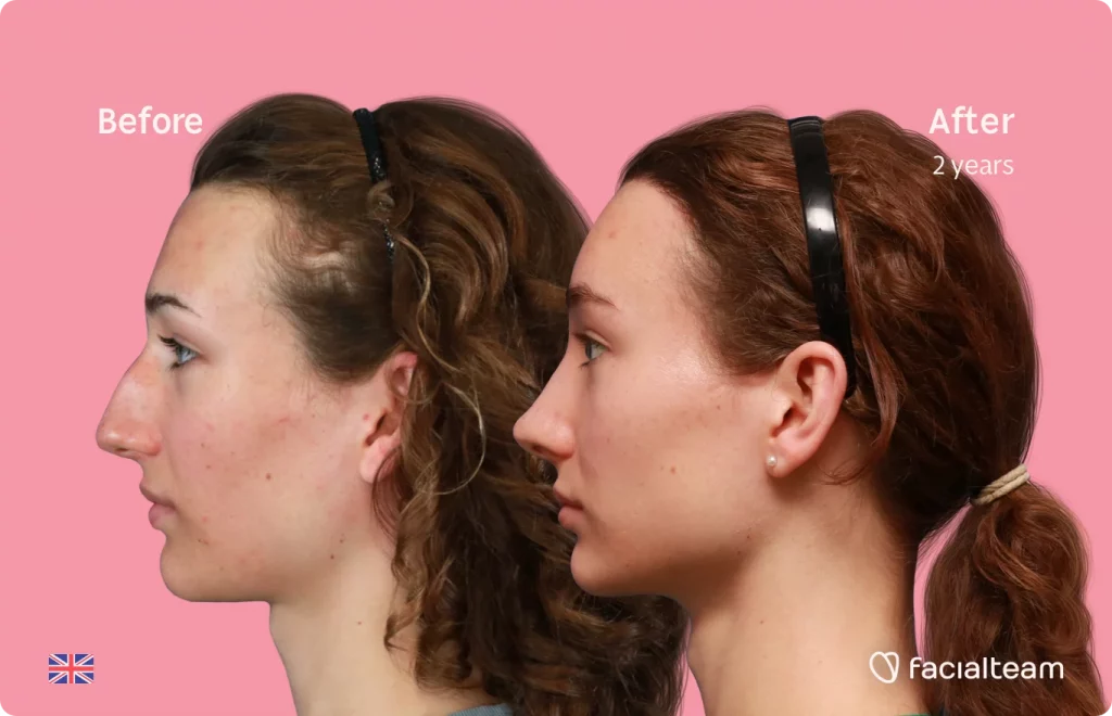 Left side image of FFS patient Amelia showing the results before and after facial feminization surgery with Facialteam consisting of forehead with SHT and rhinoplasty.