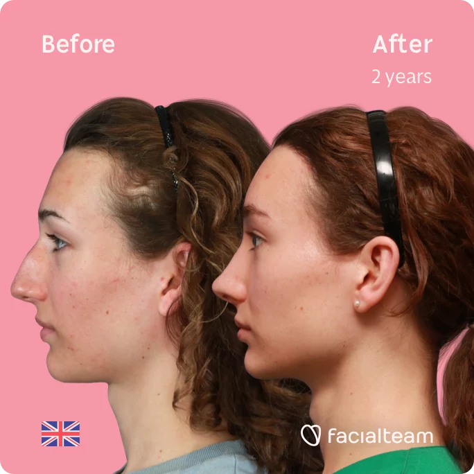 Square left side image of FFS patient Amelia showing the results before and after facial feminization surgery with Facialteam consisting of forehead with SHT and rhinoplasty.
