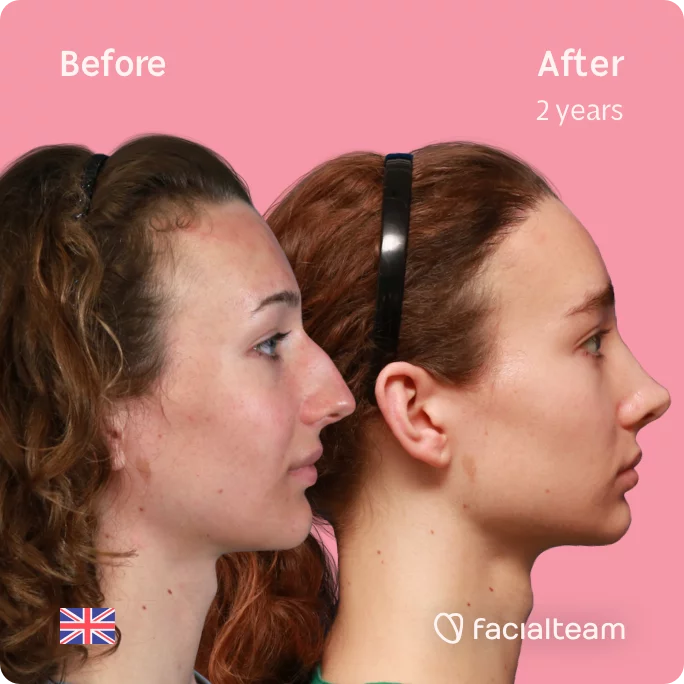 Square right side image of FFS patient Amelia showing the results before and after facial feminization surgery with Facialteam consisting of forehead with SHT and rhinoplasty.