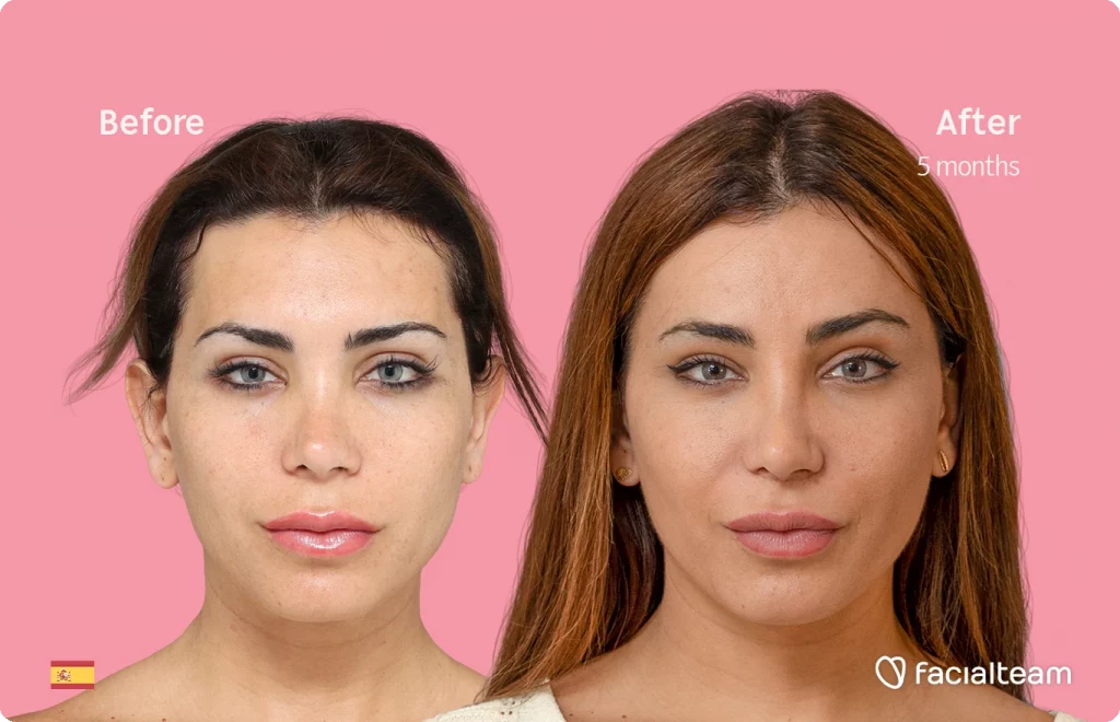Frontal image of FFS patient Daniela R showing the results before and after facial feminization surgery with Facialteam consisting of forehead and lip feminization.