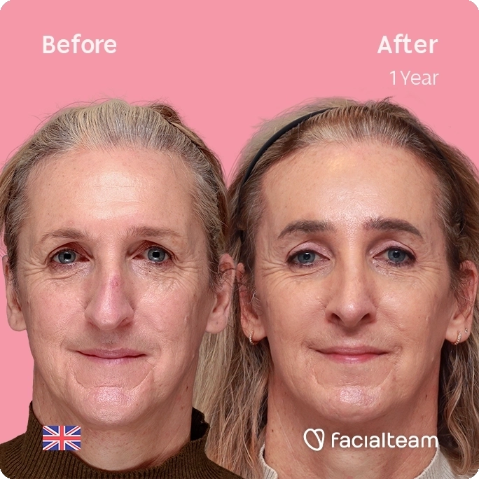 Square frontal image of FFS patient Beth showing the results before and after facial feminization surgery with Facialteam consisting of forehead, chin, rhinoplasty and blepharoplasty.