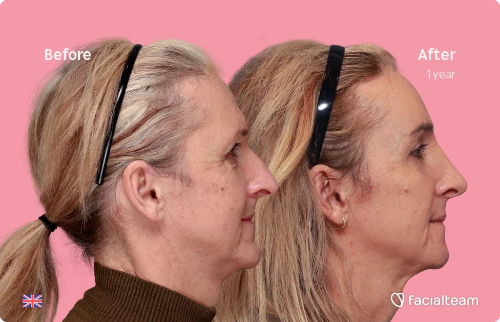 Side image of FFS patient Beth showing the results before and after facial feminization surgery with Facialteam consisting of forehead, chin, rhinoplasty and blepharoplasty.