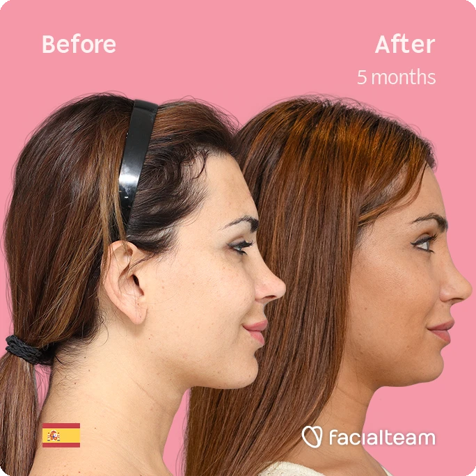 Square side image of FFS patient Daniela R showing the results before and after facial feminization surgery with Facialteam consisting of forehead and lip feminization.