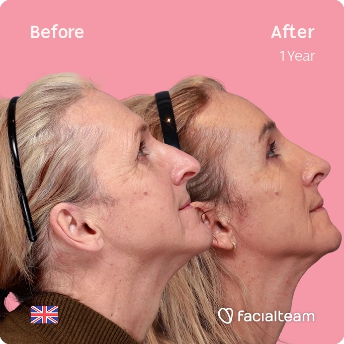 Square side up image of FFS patient Beth showing the results before and after facial feminization surgery with Facialteam consisting of forehead, chin, rhinoplasty and blepharoplasty.
