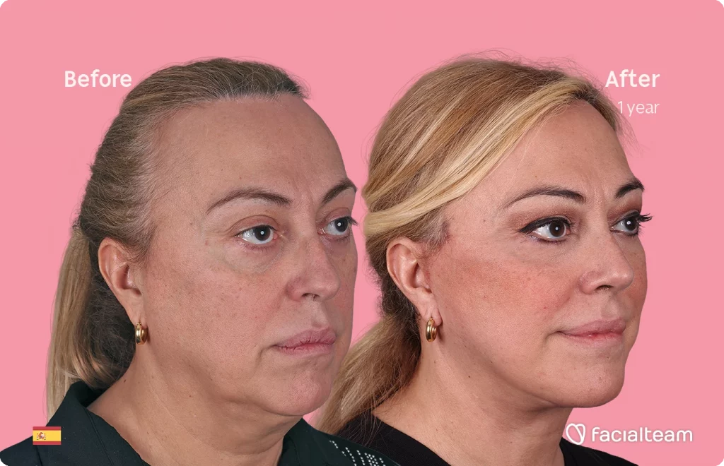 45 degree angle image of FFS patient Ana showing the results before and after facial feminization surgery with Facialteam consisting of deep plane facelift, nose and lip.