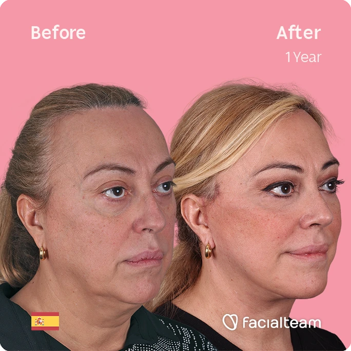 Square 45 degree angle image of FFS patient Ana showing the results before and after facial feminization surgery with Facialteam consisting of deep plane facelift, nose and lip.