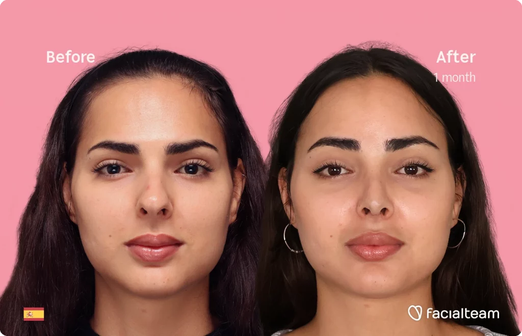 Frontal image of FFS patient Ariana showing the results before and after facial feminization surgery with Facialteam consisting of forehead and rhinoplasty.