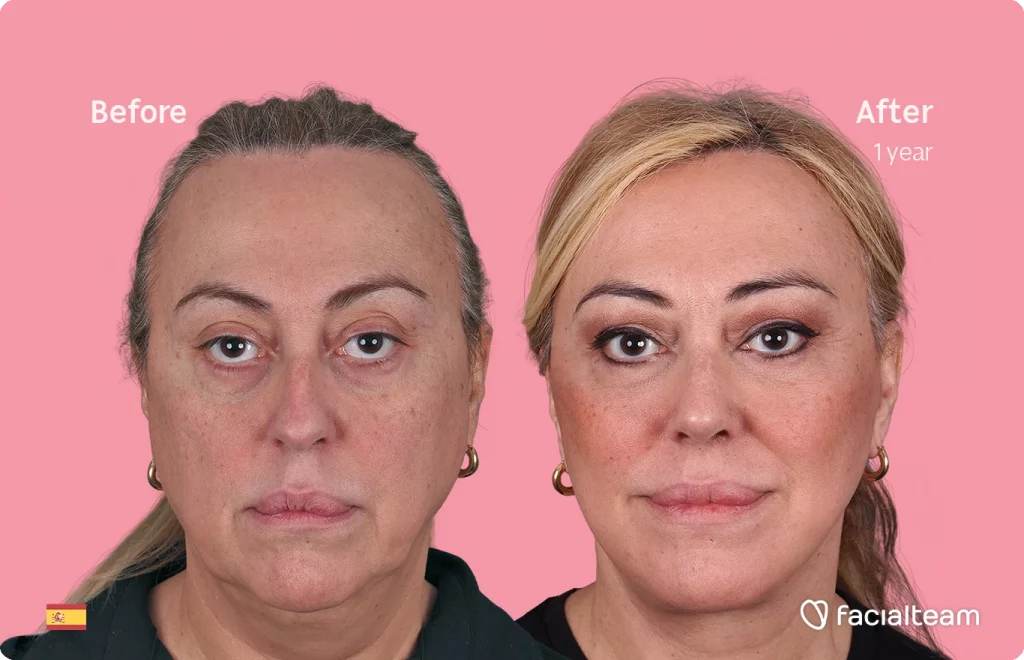 Frontal image of FFS patient Ana showing the results before and after facial feminization surgery with Facialteam consisting of deep plane facelift, nose and lip.