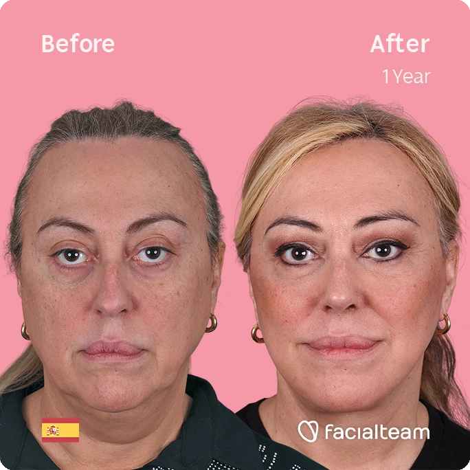 Square frontal image of FFS patient Ana showing the results before and after facial feminization surgery with Facialteam consisting of deep plane facelift, nose and lip.