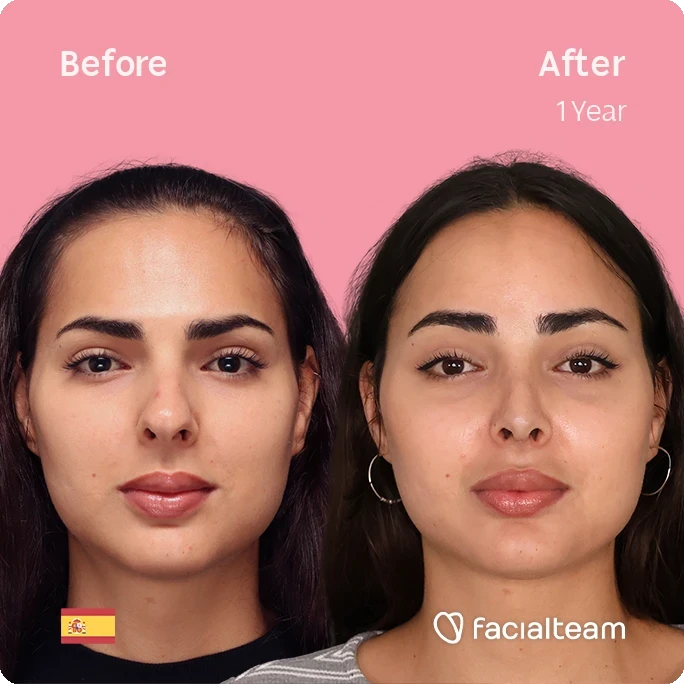Square frontal image of FFS patient Ariana showing the results before and after facial feminization surgery with Facialteam consisting of forehead and rhinoplasty.