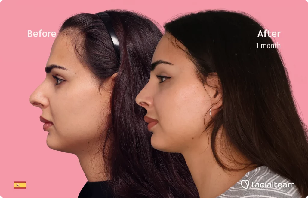 Left side image of FFS patient Ariana showing the results before and after facial feminization surgery with Facialteam consisting of forehead and rhinoplasty.