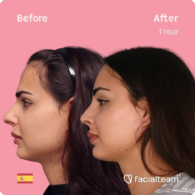 Square left side image of FFS patient Ariana showing the results before and after facial feminization surgery with Facialteam consisting of forehead and rhinoplasty.
