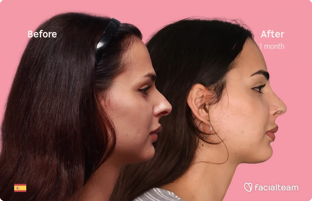 Right side image of FFS patient Ariana showing the results before and after facial feminization surgery with Facialteam consisting of forehead and rhinoplasty.