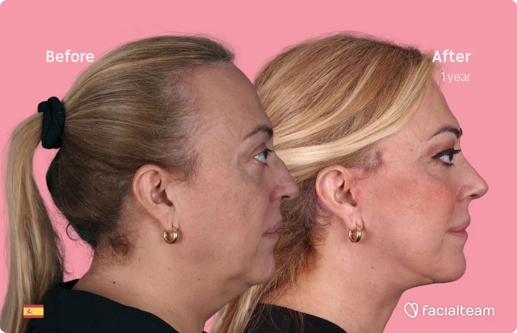 Side image of FFS patient Ana showing the results before and after facial feminization surgery with Facialteam consisting of deep plane facelift, nose and lip.