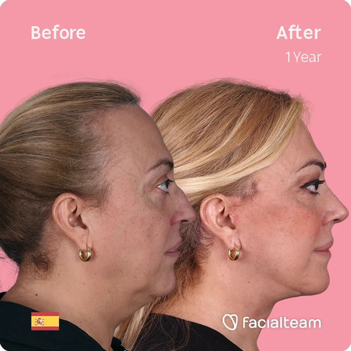 Square side image of FFS patient Ana showing the results before and after facial feminization surgery with Facialteam consisting of deep plane facelift, nose and lip.