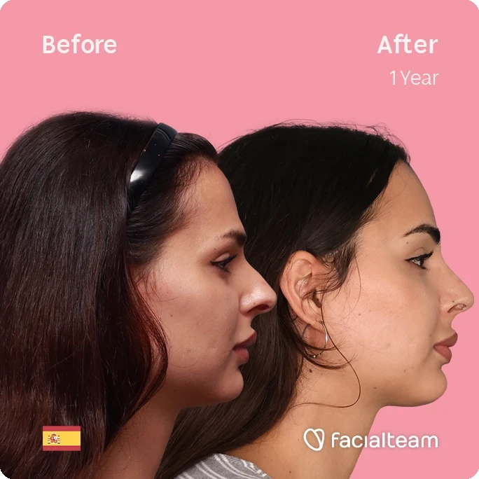 Square right side image of FFS patient Ariana showing the results before and after facial feminization surgery with Facialteam consisting of forehead and rhinoplasty.