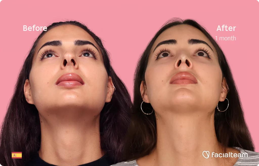 Frontal up image of FFS patient Ariana showing the results before and after facial feminization surgery with Facialteam consisting of forehead and rhinoplasty.