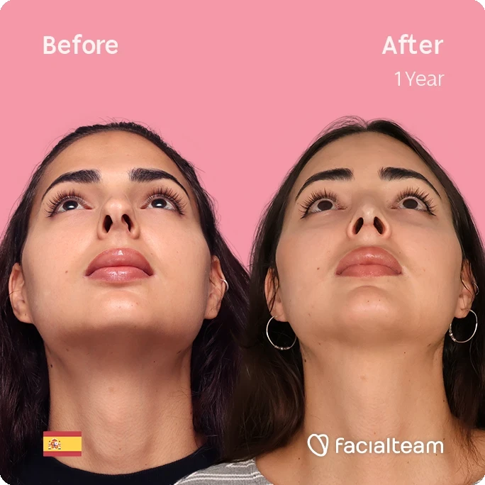 Square frontal up image of FFS patient Ariana showing the results before and after facial feminization surgery with Facialteam consisting of forehead and rhinoplasty.