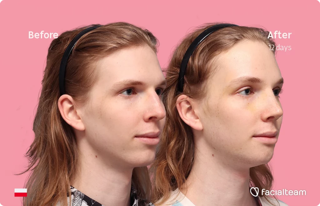 Angeled image of FFS patient Victoria W showing the results before and after facial feminization surgery with Facialteam consisting of forehead, rhinoplasty and chin feminization.
