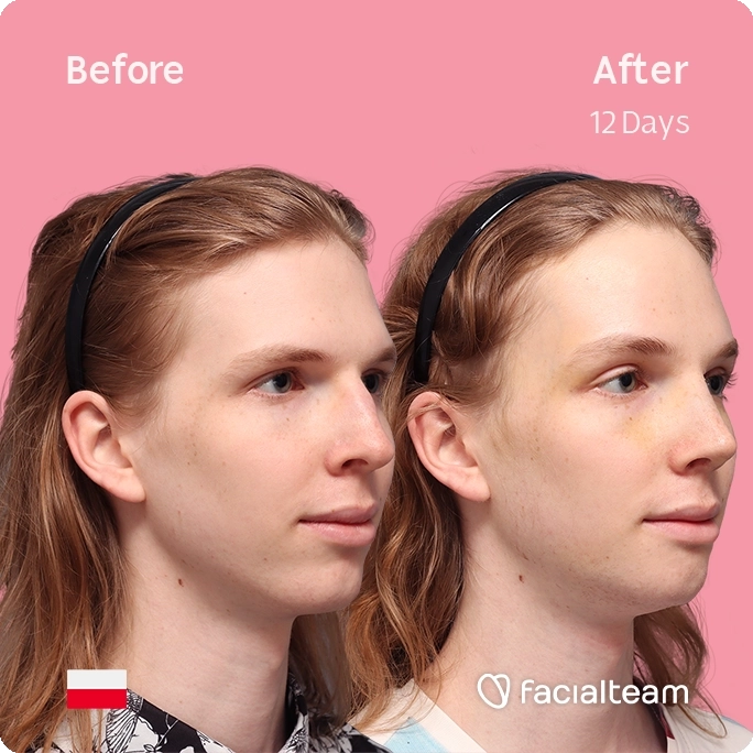 Square angeled image of FFS patient Victoria W showing the results before and after facial feminization surgery with Facialteam consisting of forehead, rhinoplasty and chin feminization.