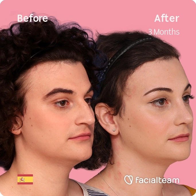 Square 45 degree right angle image of FFS patient Elizabeth showing the results before and after facial feminization surgery with Facialteam consisting of forehead, jaw and chin feminization and rhinoplasty.