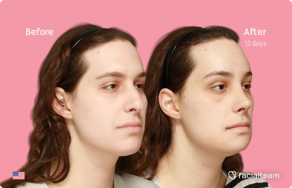Angeled image of FFS patient Robin showing the results before and after facial feminization surgery with Facialteam consisting of forehead, rhinoplasty and chin feminization.