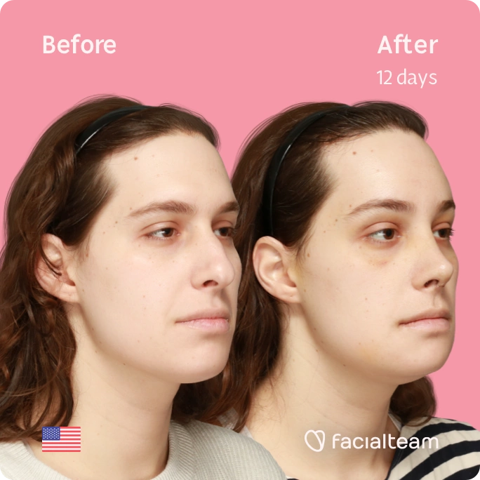 Square angeled image of FFS patient Robin showing the results before and after facial feminization surgery with Facialteam consisting of forehead, rhinoplasty and chin feminization.