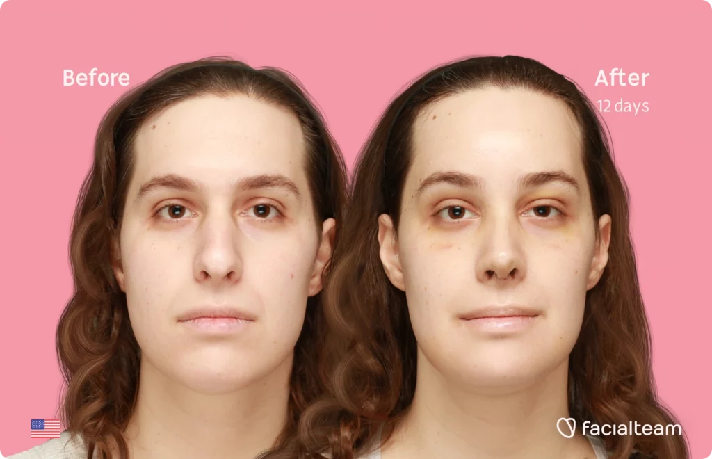 Frontal image of FFS patient Robin showing the results before and after facial feminization surgery with Facialteam consisting of forehead, rhinoplasty and chin feminization.